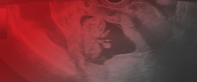 Life-Threatening Obstetrical Emergency: Spontaneous Uterine Rupture Associated with Placenta Percreta in the First Trimester of Pregnancy&mdash;Case Report and Literature Review