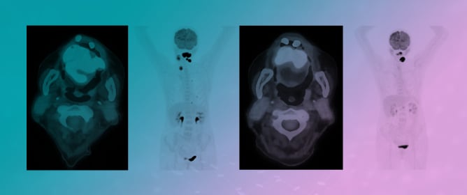 Prognostic Role of Pre- and Post-Treatment [18F]FDG PET/CT in Squamous Cell Carcinoma of the Oropharynx in Patients Treated with Chemotherapy and Radiotherapy