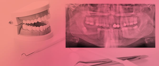 Facial Cellulitis of Unusual Odontogenic Origin