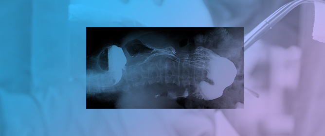 Simultaneous Laparoscopic Surgery for Esophageal Achalasia Combined with Epiphrenic Diverticulum: A Case Report