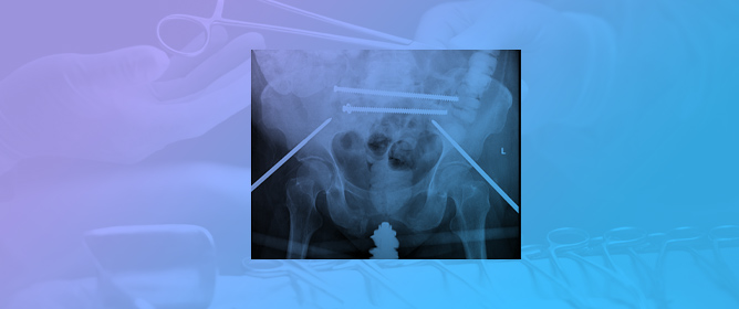 Fixation of Sacral Ala Fracture Using a Midfoot Mesh Plate as a Cannulated Screw Washer: A Case Report