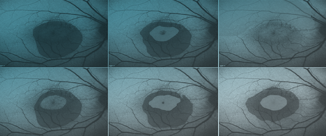 When Two Eyes Don&rsquo;t Suffice&mdash;Learning Difficult Hyperfluorescence Segmentations in Retinal Fundus Autofluorescence Images via Ensemble Learning