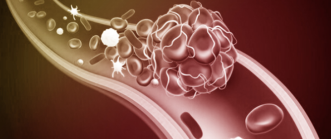 Anti-IL-6 Receptor Treatment in Giant Cell Arteritis Patients Reduces Levels of IL-1&beta;-Receptor Antagonist but Not IL-1&beta;