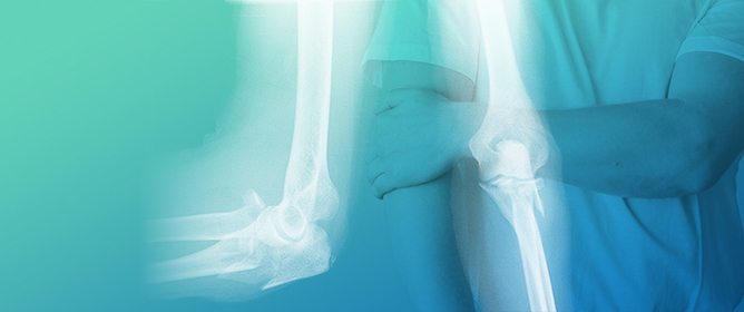 The Trans-Olecranon Approach for a Concomitant Radial Head Arthroplasty and Internal Fixation of the Ulna in Monteggia-Equivalent Fractures