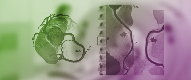 Coronary Computed Tomography Angiography (CTA) Findings in COVID-19