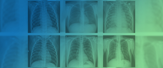 Optimizing Lung Condition Categorization through a Deep Learning Approach to Chest X-Ray Image Analysis