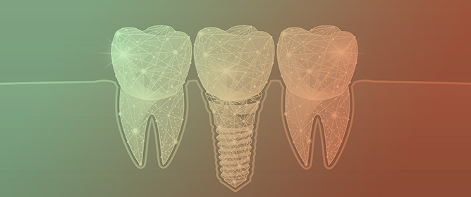 Single Dental Implant Restoration: Cemented or Screw-Retained?