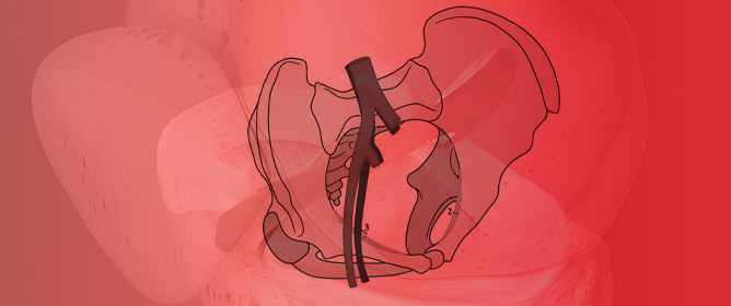 Enhanced Biomechanical Properties of the Pectineal Ligament Support Its Reliability for Apical Pelvic Organ Prolapse Repair