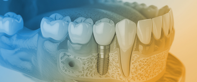 The Effect of Increasing Thread Depth on the Initial Stability of Dental Implants: An In Vitro Study