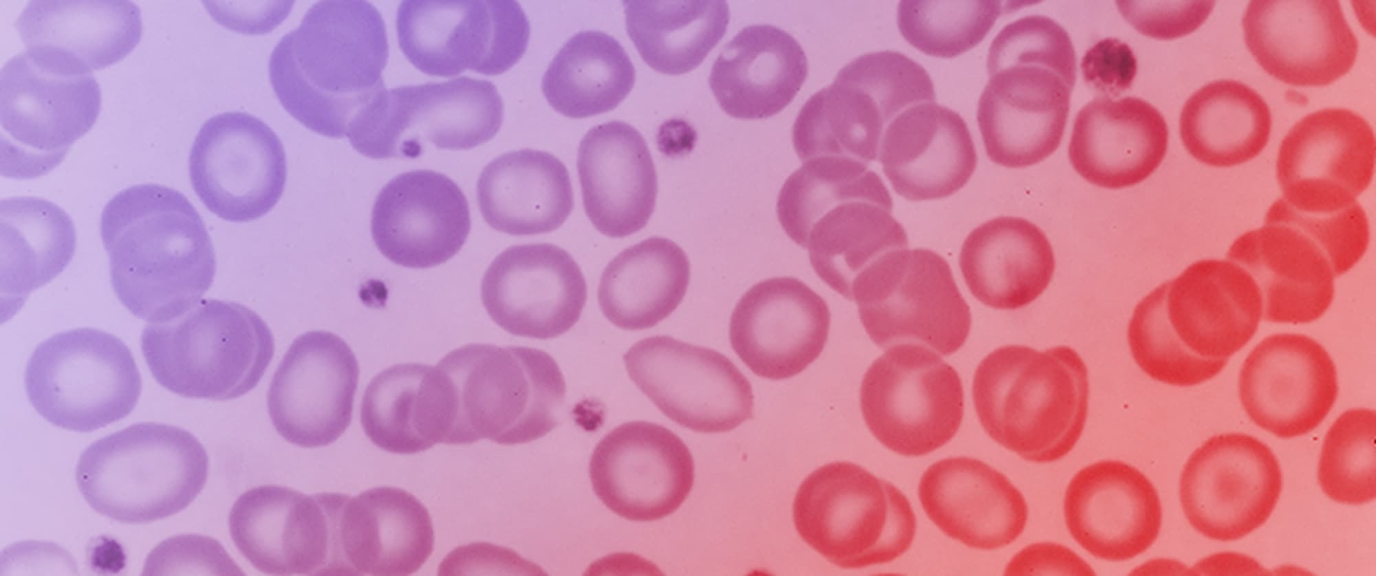 Genotype-Phenotype Correlation in a Couple in Which Both Have Microcytic Non-Sideropenic Anaemia