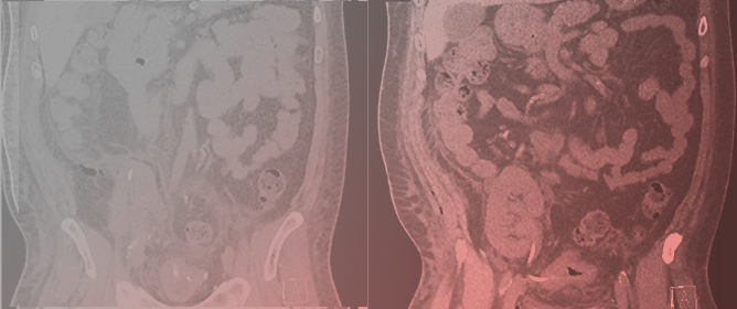 Calcified Hematoma Following Kidney Transplant Perforation by Ureteral Stent