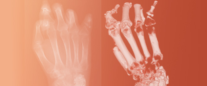 Insights and Future Perspectives in Calcinosis Cutis Associated with Systemic Sclerosis