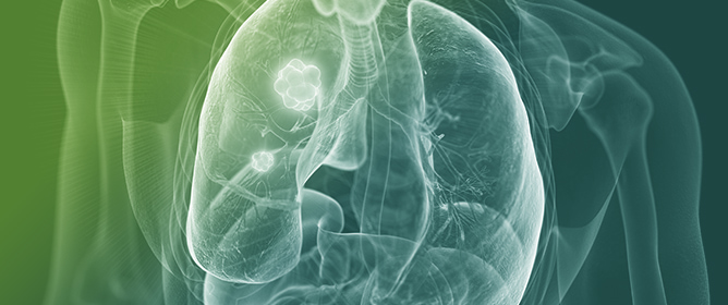 Advanced Lung Cancer Inflammation Index as Predictor of All-Cause Mortality in ST-Elevation Myocardial Infarction Patients Undergoing Primary Percutaneous Coronary Intervention