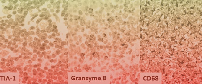 Nodular Lymphocyte-Predominant Hodgkin Lymphoma: A Special Type of (Follicular) B-Cell Lymphoma?