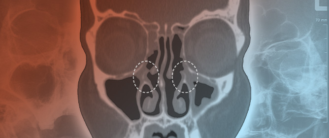 Anatomical Features Needing Attention at Revision Endoscopic Sinus Surgery