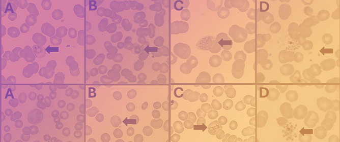 Multidisciplinary Approach of a Male Case of Imported Malaria, HIV Chronic Infection, and Latent Syphilis