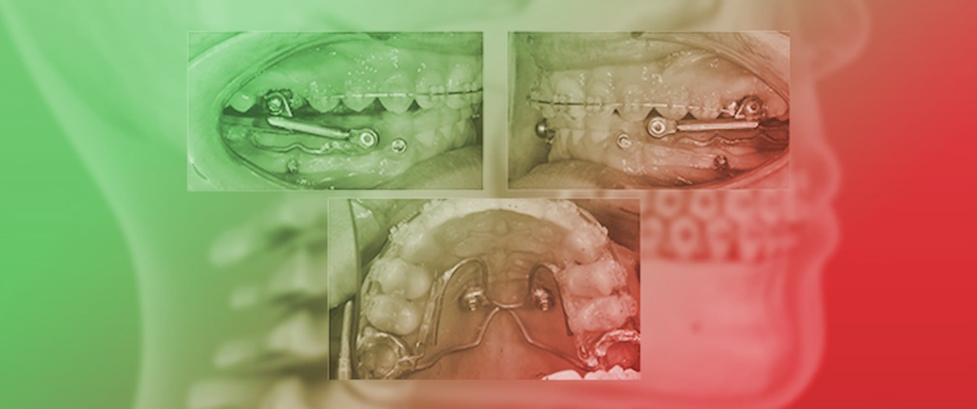 Mandibular Advancement after Pubertal Peak with Acrylic Splint Herbst Appliance Anchored to Four Miniscrews: A Retrospective Controlled Study