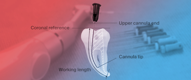 Influence of Root Canal Size and Curvature on Insertion Depth of Three Different Endodontic Irrigation Needles