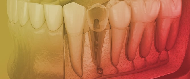 Clinical Evaluation of Buccal Infiltration with Articaine for Endodontic Anesthesia in Mandibular Molars with Irreversible Pulpitis