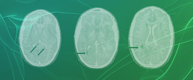 Pediatric Neuroimaging of Multiple Sclerosis and Neuroinflammatory Diseases