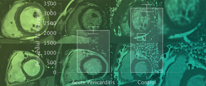 Assessing Acute Pericarditis with T1 Mapping: A Supportive Contrast-Free CMR Marker