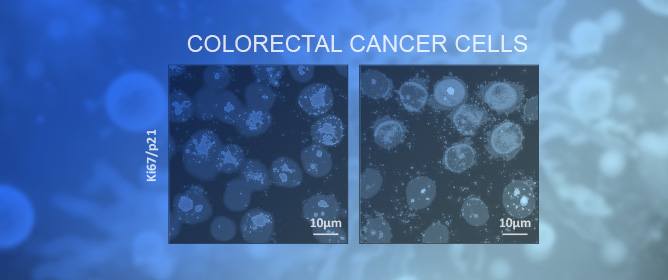 Postbiotics Improve Colorectal Cancer&ndash;Macrophage Cross-Talk