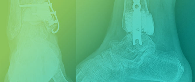 Personalized 3D-Printed Prostheses for Bone Defect Reconstruction After Tumor Resection in the Foot and Ankle