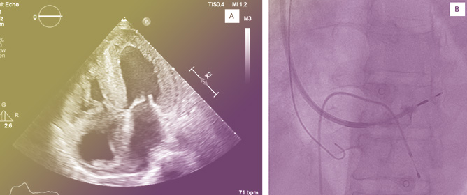 Riding the Highs and Lows of the Conduction System Pacing Wave&mdash;Our Experience