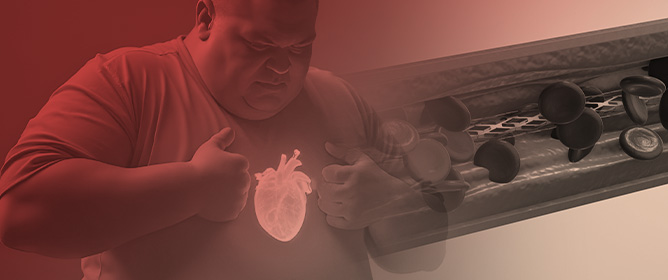 The Influence of Body Mass Index on Percutaneous Coronary Intervention Outcomes: A National Inpatient Sample Study