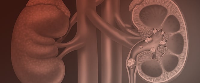 What Causes Calcium Oxalate Kidney Stones to Form? An Update on Recent Advances