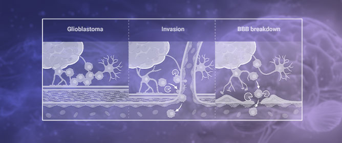 Matrix Metalloproteinases Function in Glioma Progression and Treatment