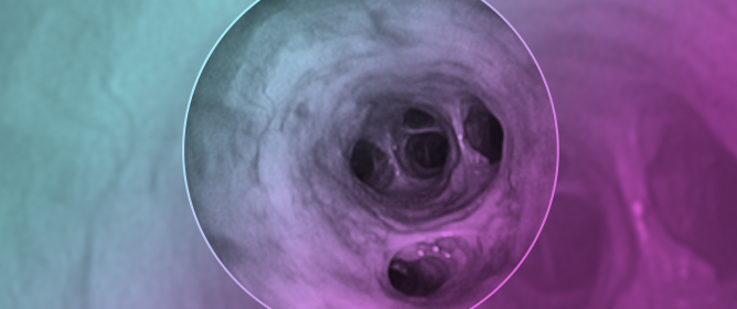 Clinical Relevance of Distinguishing Between Three Endoscopy-Based Conditions, Bronchiectasis, Bronchomalacia, and Their Combination in Dogs: A Retrospective Study