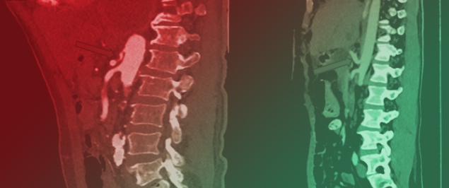 Median Arcuate Ligament Syndrome: From Diagnosis to Multidisciplinary Management&mdash;A Narrative Review