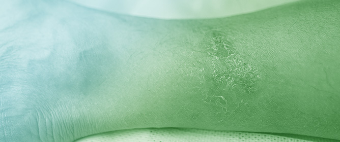 Current Advancements in Burn Healing