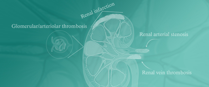 Perspective on Renal Involvement in Antiphospholipid Syndrome: Implications for Diagnosis, Pathogenesis, and Treatment