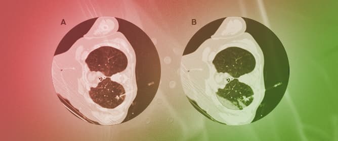 Ground-Glass Opacities and Highly Perfused Lung Areas as Risk Factors for Pulmonary Hemorrhage in CT-Guided Lung Biopsy