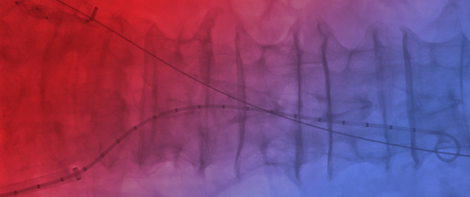 Mid-Term Outcomes of the Double-Barrel Technique for Patients Who Are Unfit for Standard Endovascular Aortic Aneurysm Repair