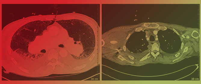 Diagnostic and Management Challenges of Subclavian Artery Aneurysms in the Setting of MRSA Bacteremia and UEDVT