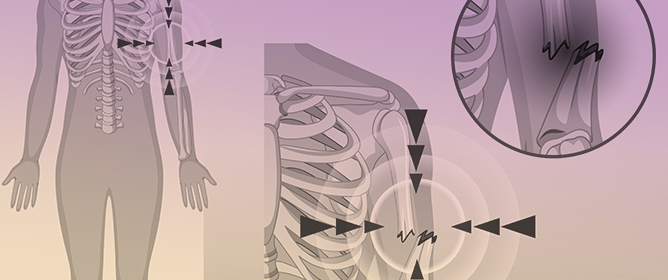 Mechanotransduction and Skeletal Muscle Atrophy: The Interplay Between Focal Adhesions and Oxidative Stress