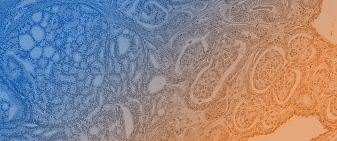 SIU-ICUD: Localized Prostate Cancer: Pathological Factors That Influence Outcomes and Management