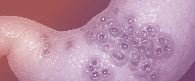 Patients with Gastrointestinal Bleeding and Atrial Fibrillation: Potential Ideal Target for Epicardial Appendage Occlusion