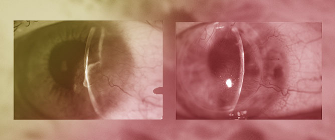 Corneal Neovascularisation and Anti-VEGF Therapy