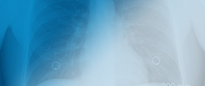Epidemiology of Symptomatic Non-Union/Malunion Rib Fractures