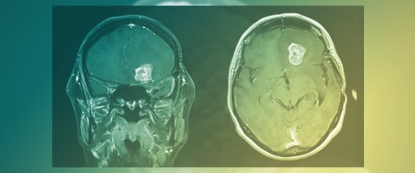 Navigating Rare Gliomas: Diagnostic Challenges and Personalized Treatment