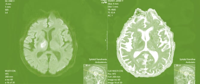 Assessing Acute DWI Lesions in Clinically Diagnosed TIA: Insights from a Cohort Study in Cluj, Romania