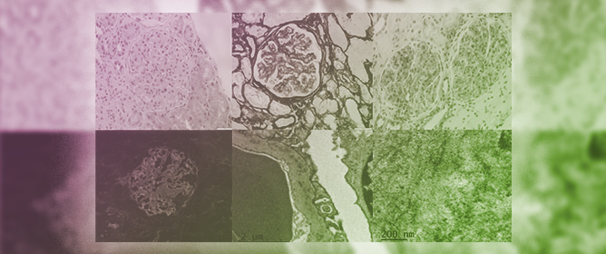 Fibrillary Glomerulonephritis Diagnosis Is Enhanced by DNAJB9: Three Cases with Different Clinical, Anatomopathologic Features and Outcomes