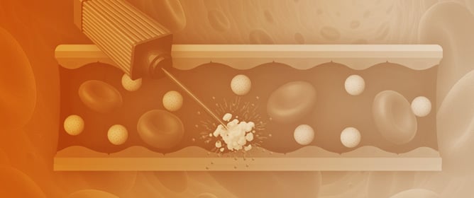 NIR-Responsive Microbubble Collapse for Precision Drug Release in Cancer Therapy