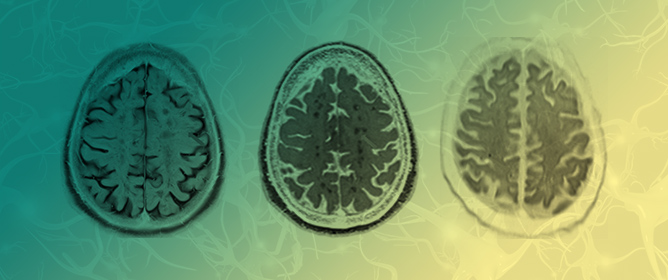 Clinical Management of Cerebral Amyloid Angiopathy