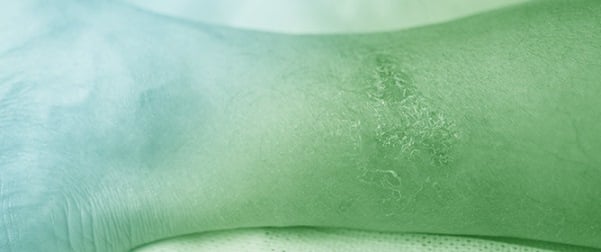 Current Advancements in Burn Healing