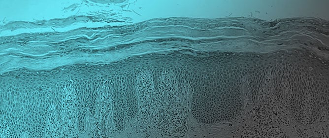 Efficacy of Dupilumab in Refractory Cutaneous Lichen Planus